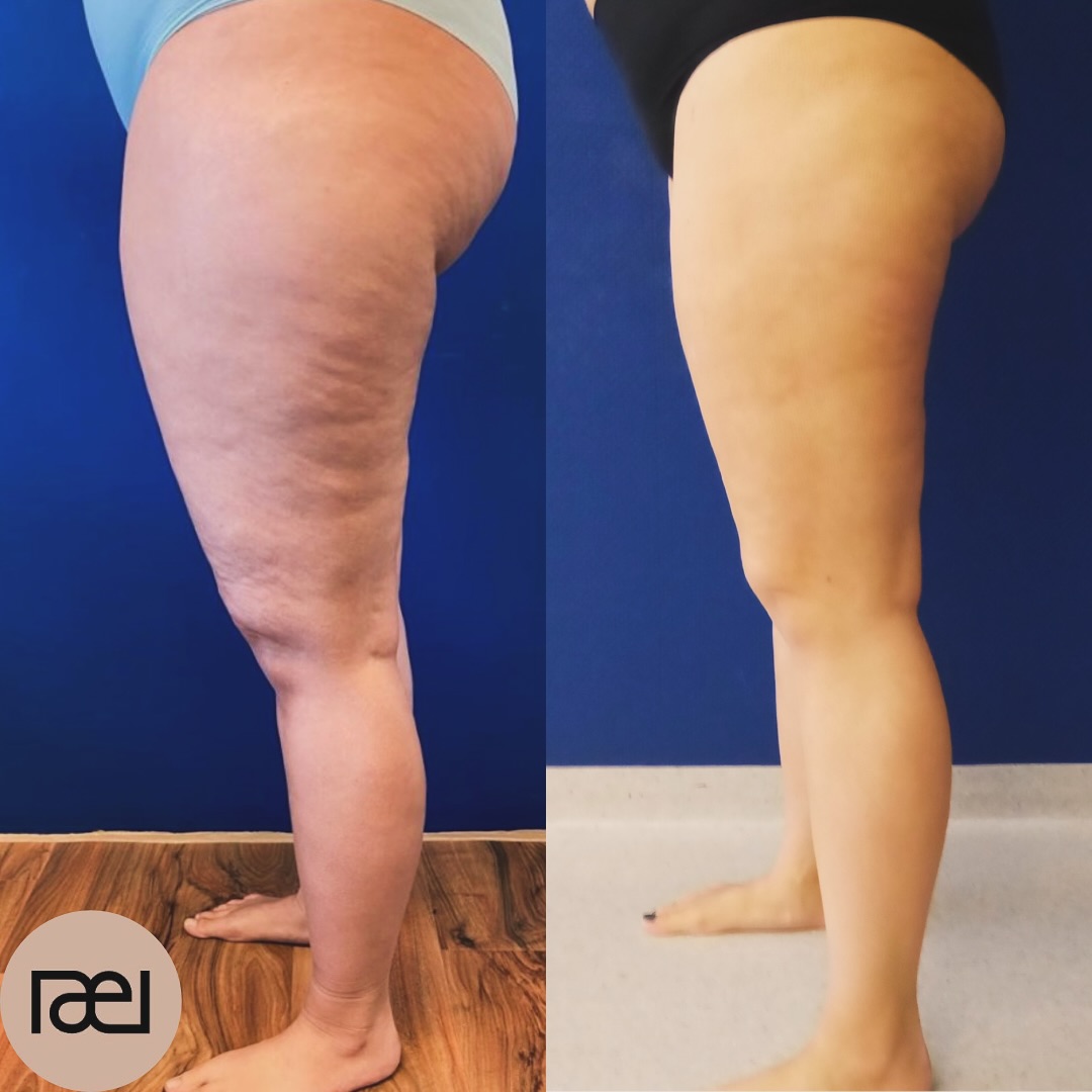 instagram fettabsaugung