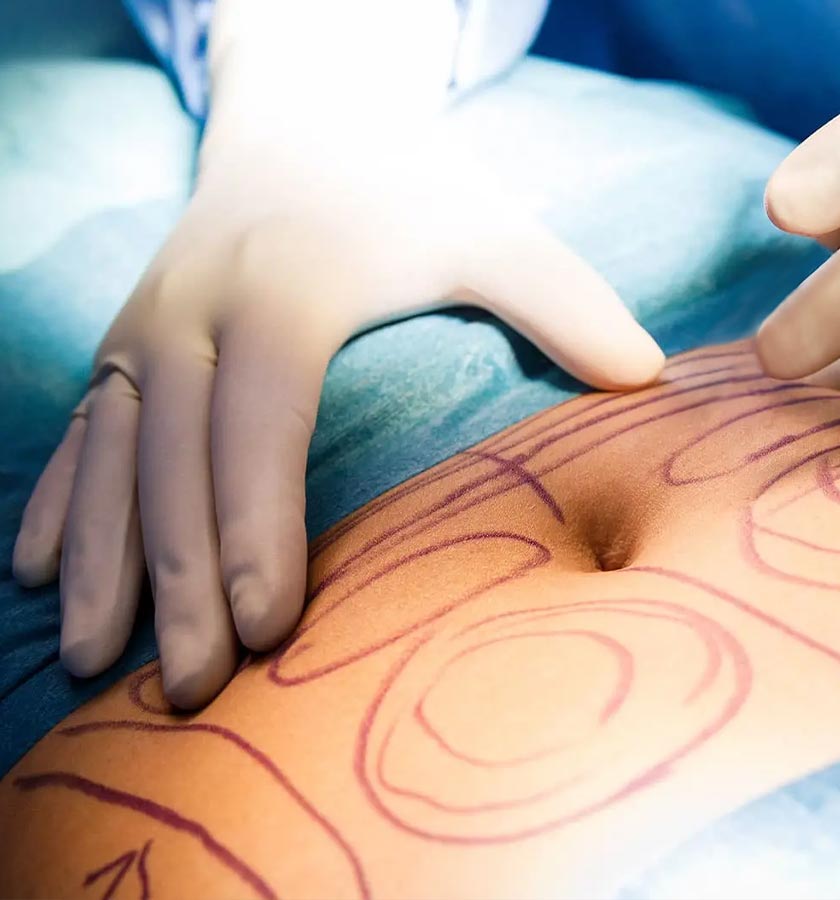 panaesthetics bauchdeckenstraffung